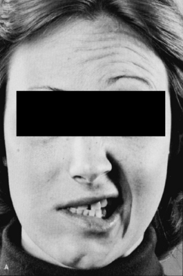 Product picture Bells Palsy