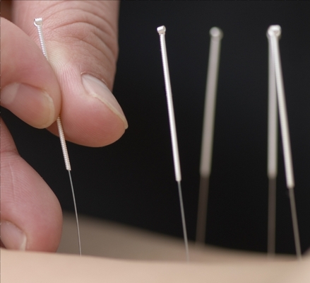 Product picture What is Acupuncture?