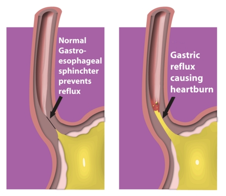 Product picture How To Prevent and Treat Heartburn or Acid Reflux 